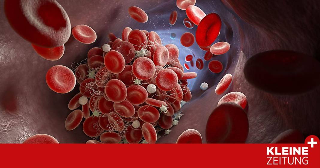 blutgerinnsel:-fragen-und-antworten-zu-thrombosen blutgerinnsel:-fragen-und-antworten-zu-thrombosen
