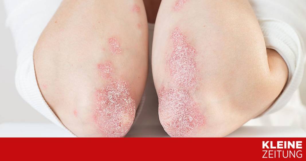 neuer-behandlungsansatz-fuer-schuppenflechte-in-erforschung
