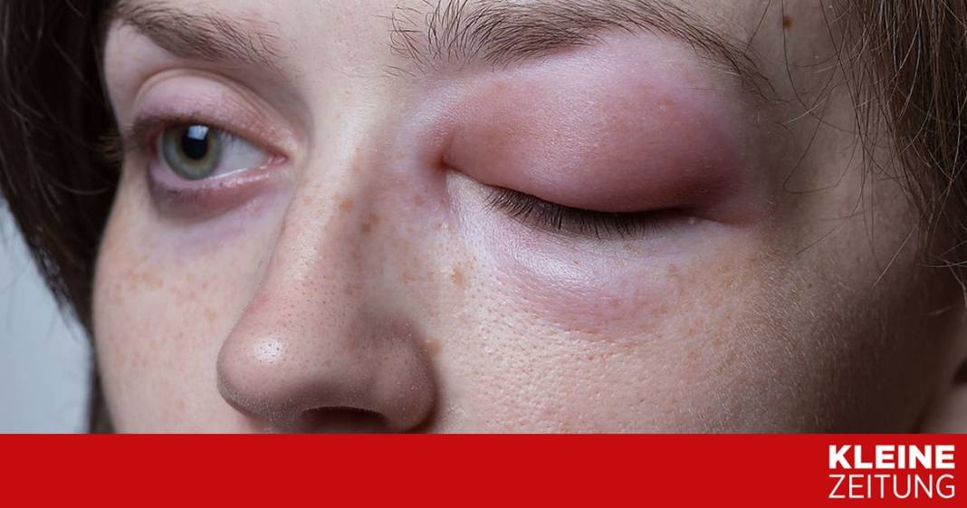 hae:-eine-seltene-krankheit,-deren-behandlung-200.000-euro-kosten-kann