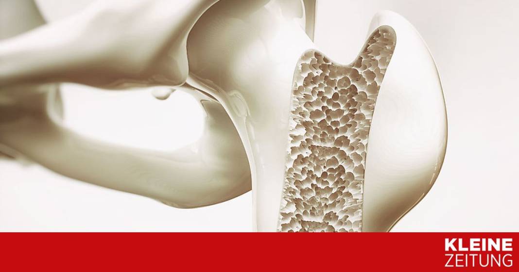 osteoporose-wird-in-oesterreich-immer-“maennlicher” osteoporose-wird-in-oesterreich-immer-“maennlicher”