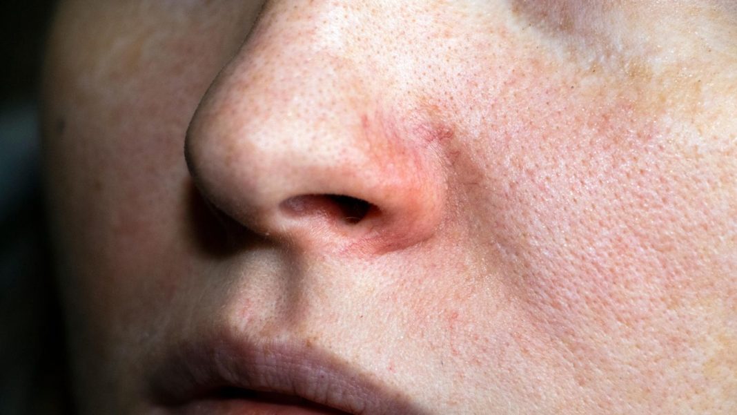 rote-aederchen-im-gesicht:-rosacea-creme-gegen-hautroetungen:-diese-produkte-lindern-die-symptome