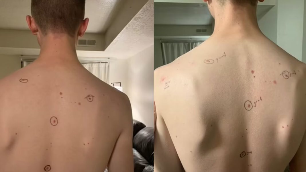 krebsvorsorge:-frau-schickt-mann-mit-edding-kreisen-zum-arzt-–-die-diagnose-schrieb-der-auf-die-haut krebsvorsorge:-frau-schickt-mann-mit-edding-kreisen-zum-arzt-–-die-diagnose-schrieb-der-auf-die-haut