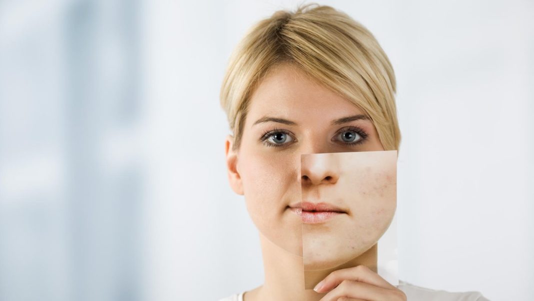 hautunreinheiten:-was-hilft-gegen-pickel?-mit-diesen-tipps-verbessern-sie-ihr-hautbild
