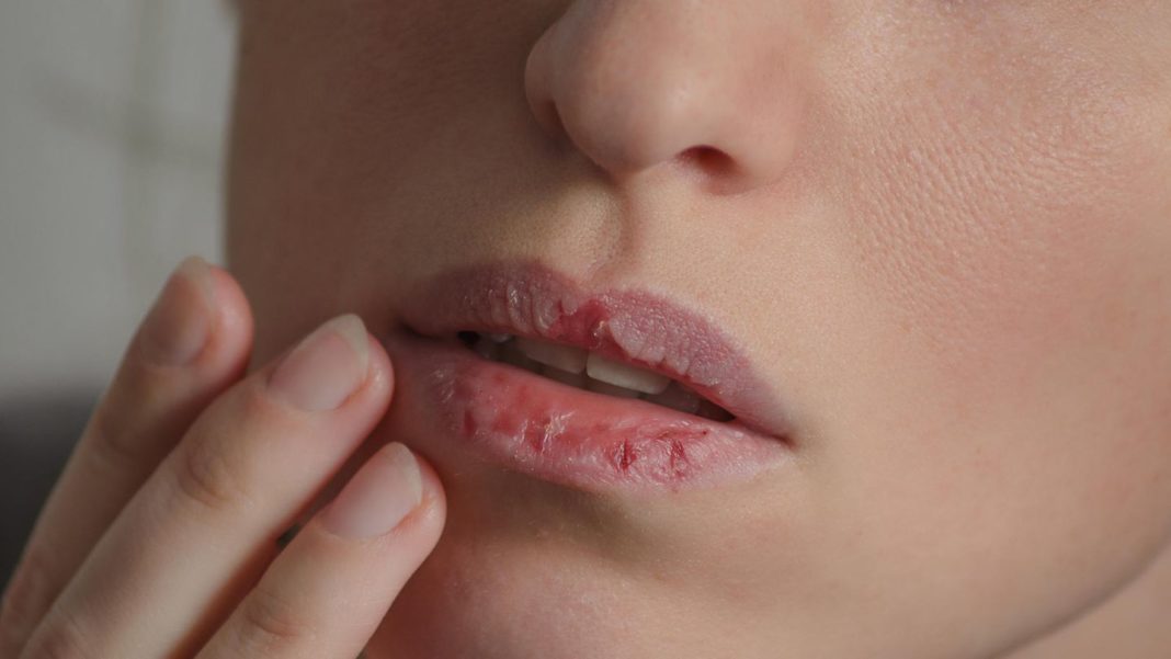 fehlender-eigenschutz:-trockene-lippen?-diese-fehler-sollten-sie-vermeiden fehlender-eigenschutz:-trockene-lippen?-diese-fehler-sollten-sie-vermeiden