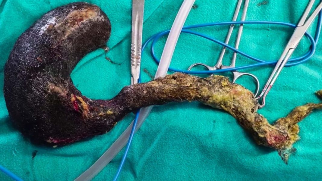 seltene-krankheit:-gewaltiger-haarklumpen:-aerzte-finden-1,5-kilogramm-haare-im-bauch-einer-sechsjaehrigen seltene-krankheit:-gewaltiger-haarklumpen:-aerzte-finden-1,5-kilogramm-haare-im-bauch-einer-sechsjaehrigen