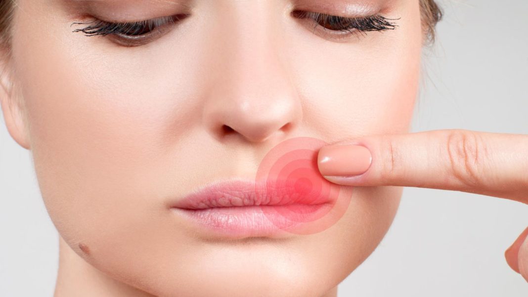 virusinfektion:-was-hilft-gegen-herpes?-so-behandeln-sie-die-lippenblaeschen-richtig virusinfektion:-was-hilft-gegen-herpes?-so-behandeln-sie-die-lippenblaeschen-richtig