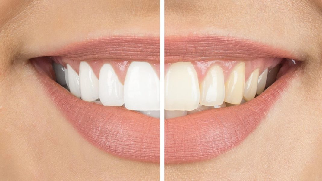 strahlend-weisses-laecheln:-bleaching-methoden-im-vergleich:-so-hellen-sie-ihre-zaehne-wieder-auf strahlend-weisses-laecheln:-bleaching-methoden-im-vergleich:-so-hellen-sie-ihre-zaehne-wieder-auf