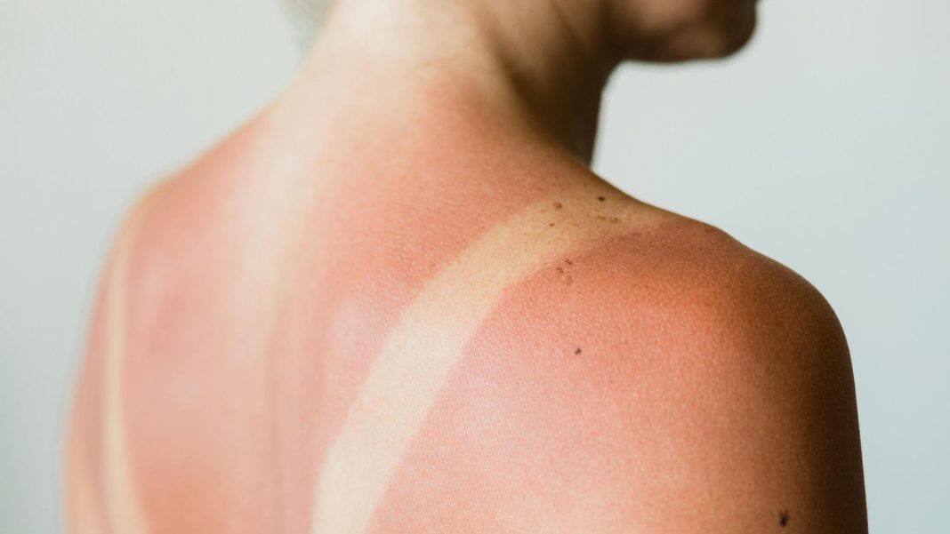 gesundheitstipps-im-check:-quark-soll-gegen-sonnenbrand-helfen-–-stimmt-das? gesundheitstipps-im-check:-quark-soll-gegen-sonnenbrand-helfen-–-stimmt-das?