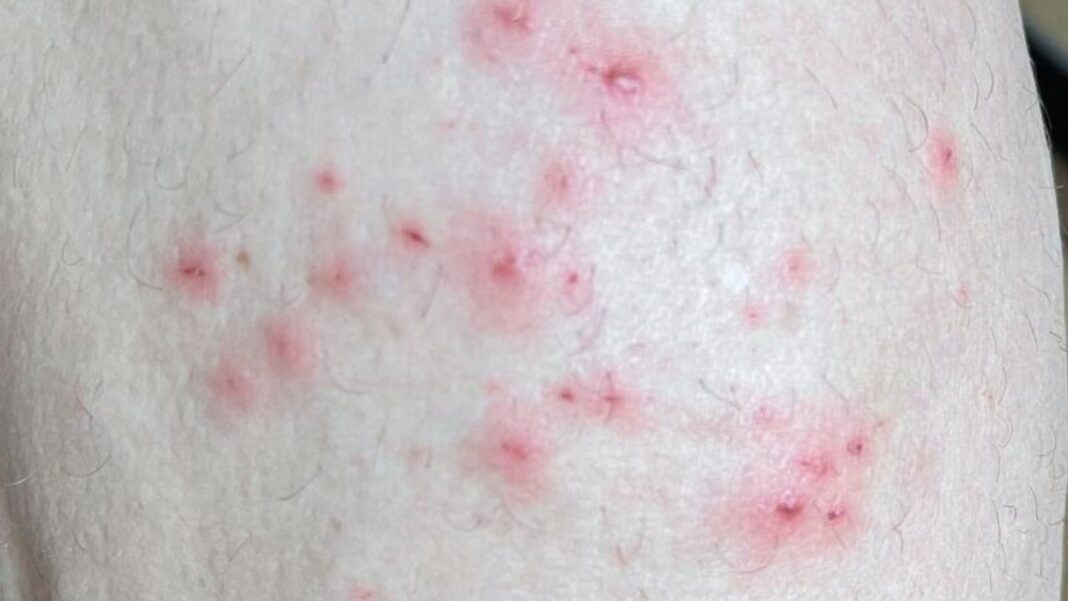 ausbruchseindaemmung:-affenpocken:-who-ruft-weltweiten-gesundheitsnotstand-aus-–-so-ist-die-aktuelle-lage-in-deutschland ausbruchseindaemmung:-affenpocken:-who-ruft-weltweiten-gesundheitsnotstand-aus-–-so-ist-die-aktuelle-lage-in-deutschland