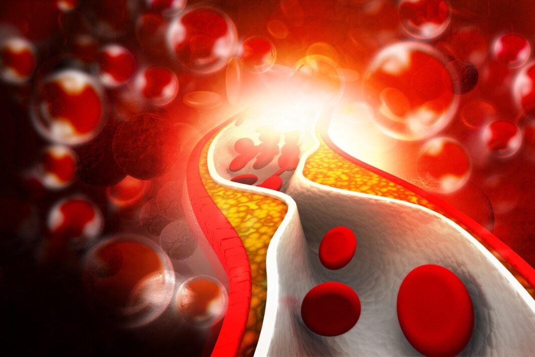 zusaetzlicher-effekt:-cholesterinsenker-verhindern-schlaganfaelle