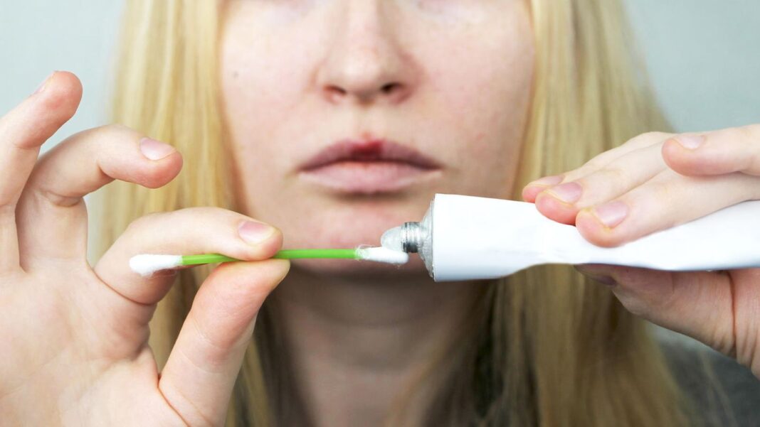 lippenblaeschen:-herpes-creme-im-vergleich:-diese-produkte-sollen-typische-symptome-lindern lippenblaeschen:-herpes-creme-im-vergleich:-diese-produkte-sollen-typische-symptome-lindern
